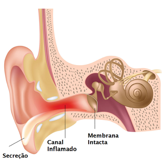 Otite externa