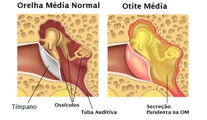 Otite média infecciosa