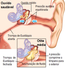 Otite média serosa